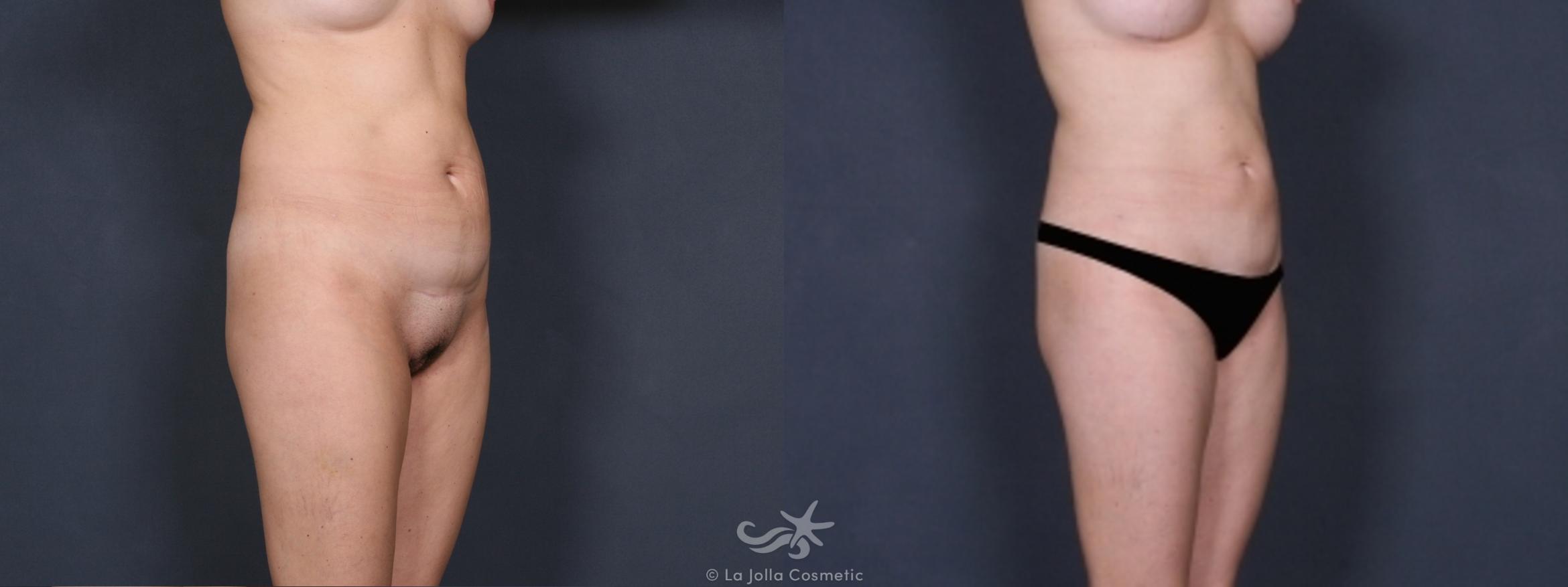 Before & After Liposuction Result 315 Right Oblique View in San Diego, CA