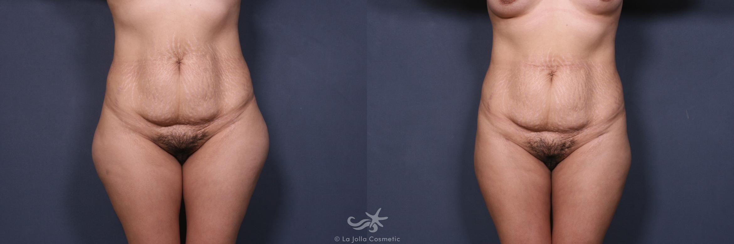 Before & After Liposuction Result 336 Front View in San Diego, CA