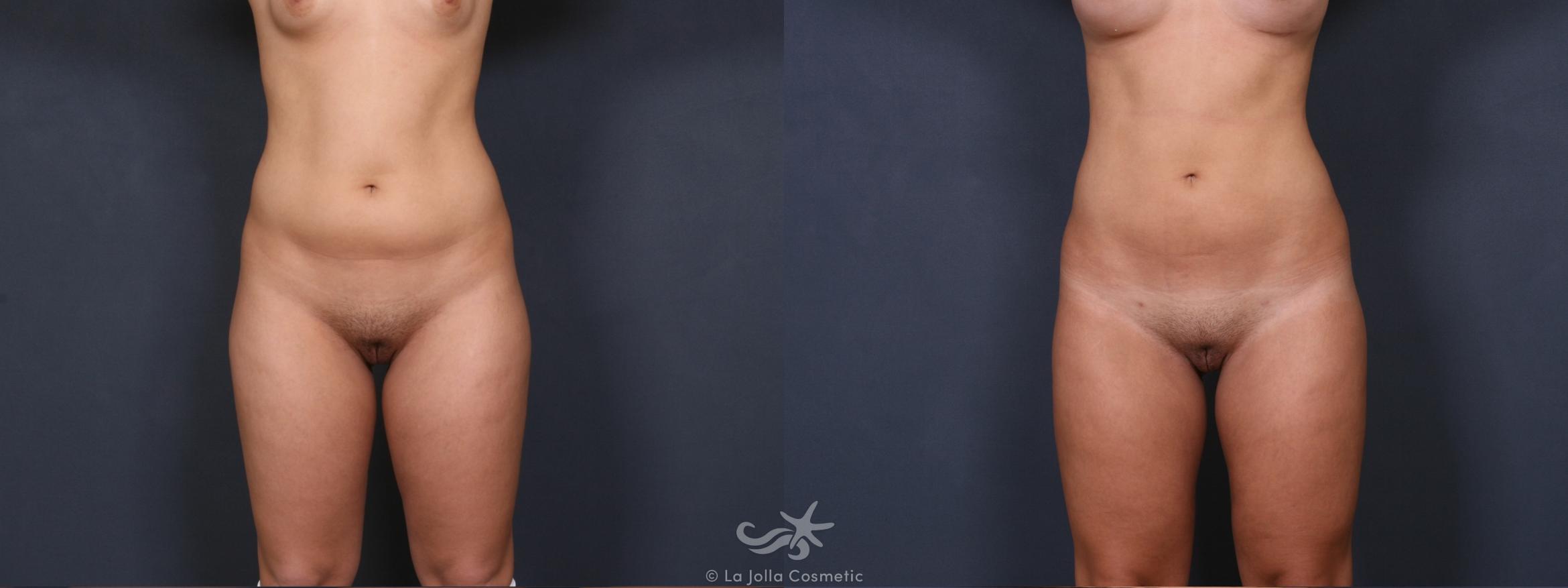 Before & After Liposuction Result 340 Front View in San Diego, CA