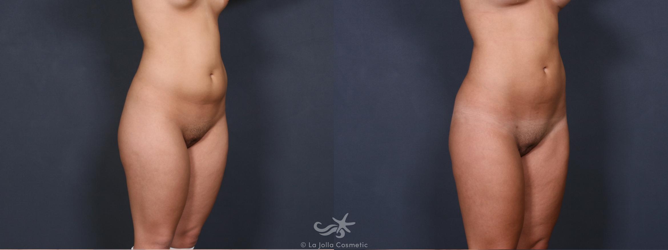 Before & After Liposuction Result 340 Right Oblique View in San Diego, CA