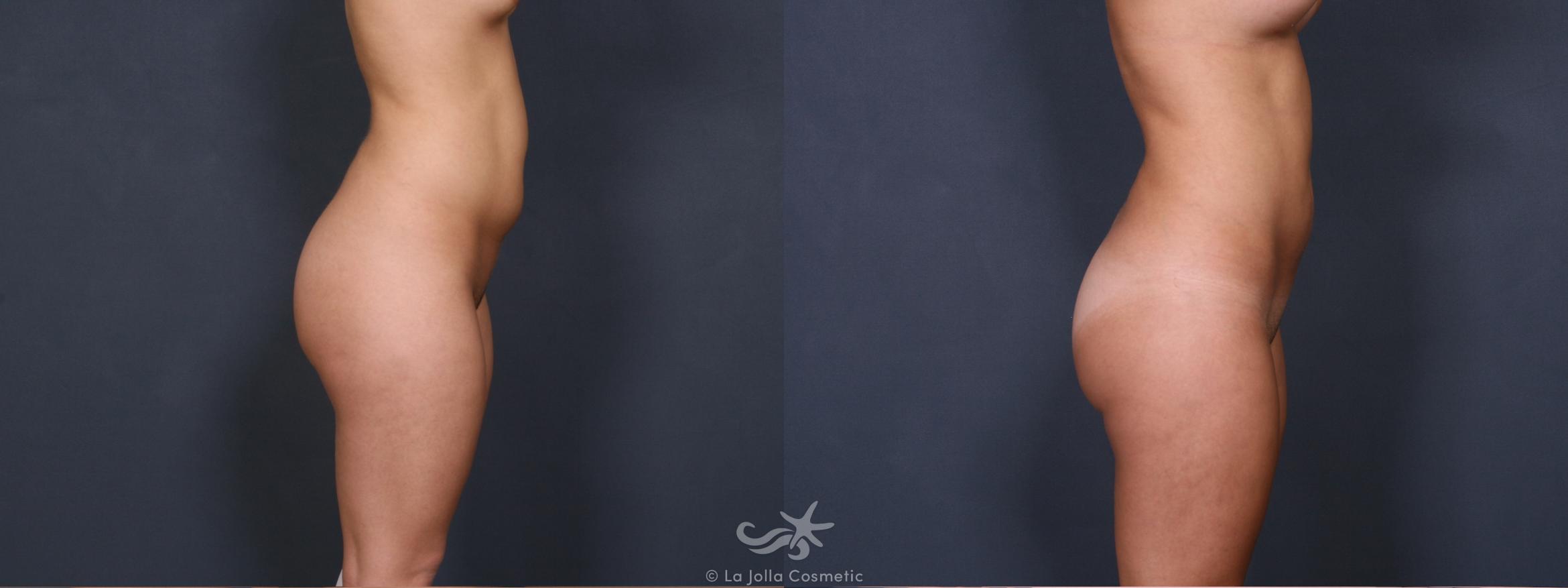 Before & After Liposuction Result 340 Right Side View in San Diego, CA