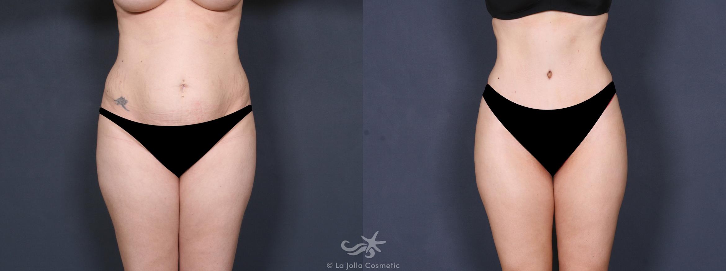 Before & After Liposuction Result 346 Front View in San Diego, CA