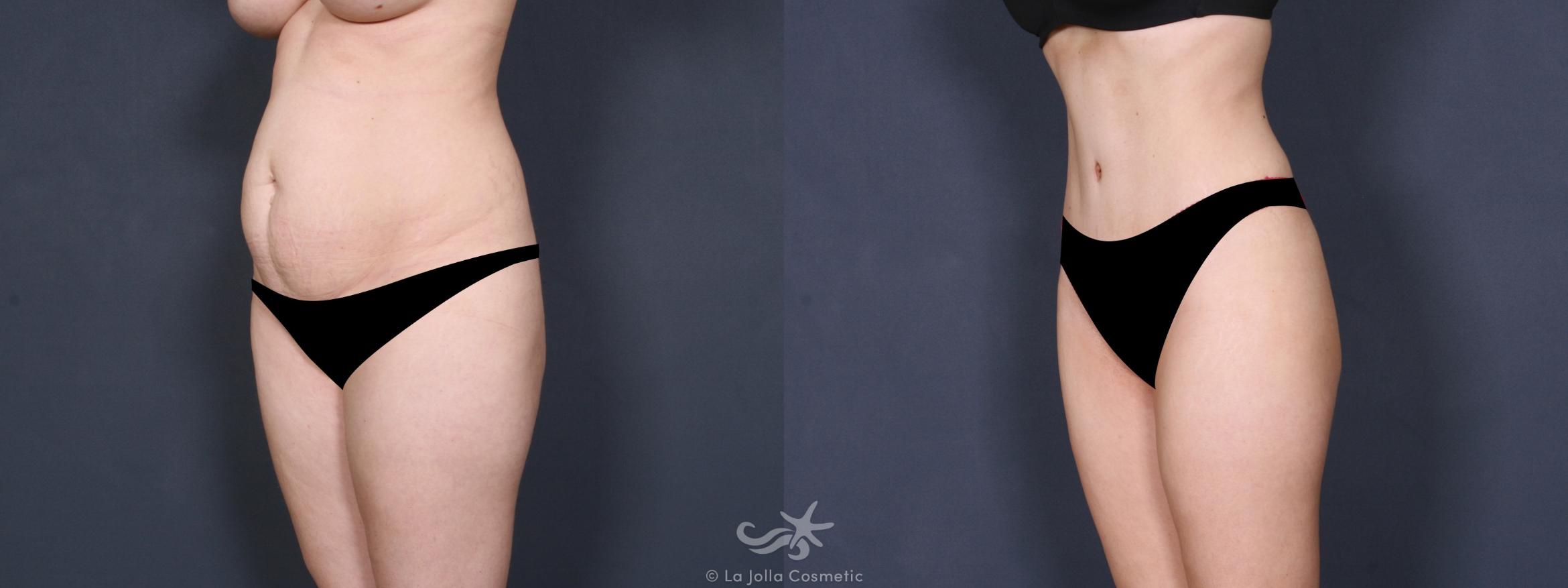 Before & After Liposuction Result 346 Left Oblique View in San Diego, CA