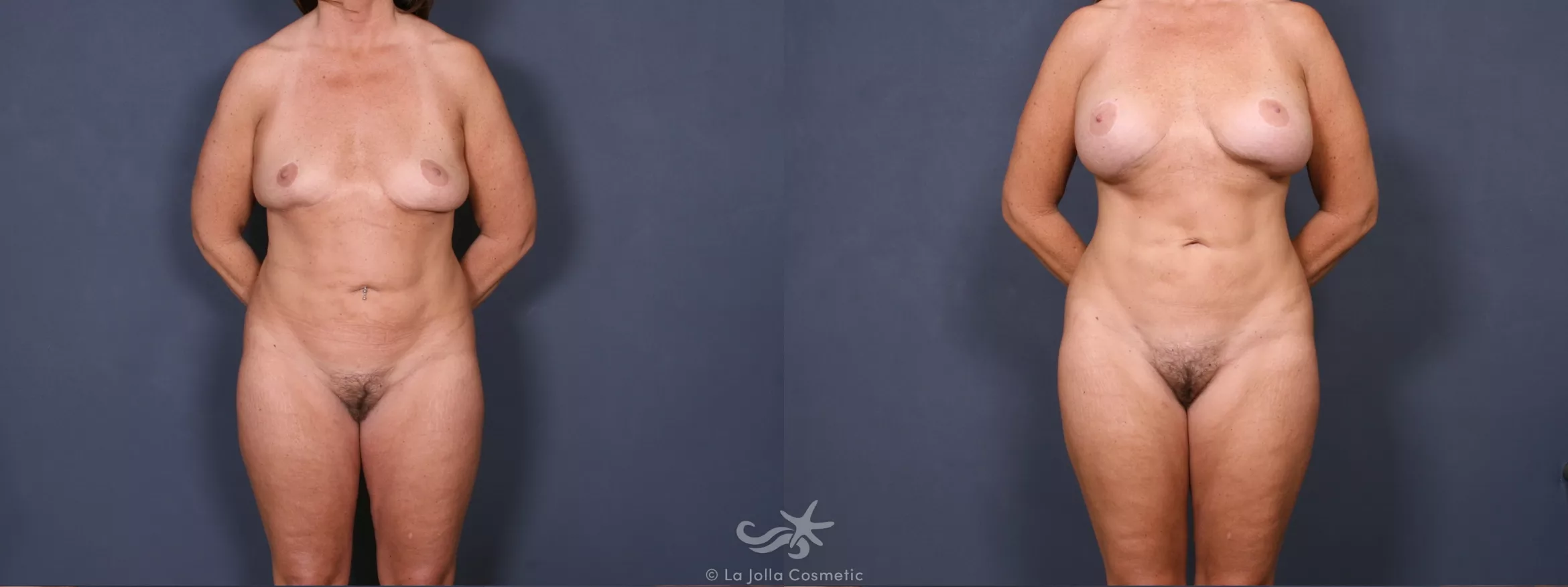 Before & After Liposuction Result 347 Front View in San Diego, CA