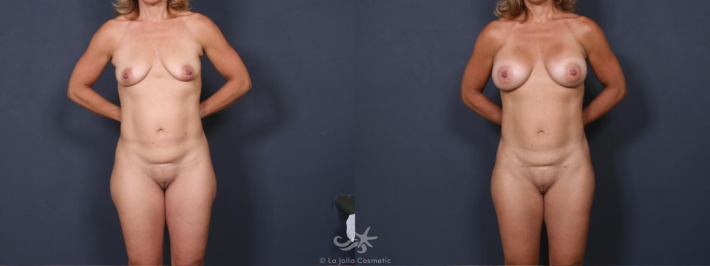 Before & After Liposuction Result 360 Front View in San Diego, CA