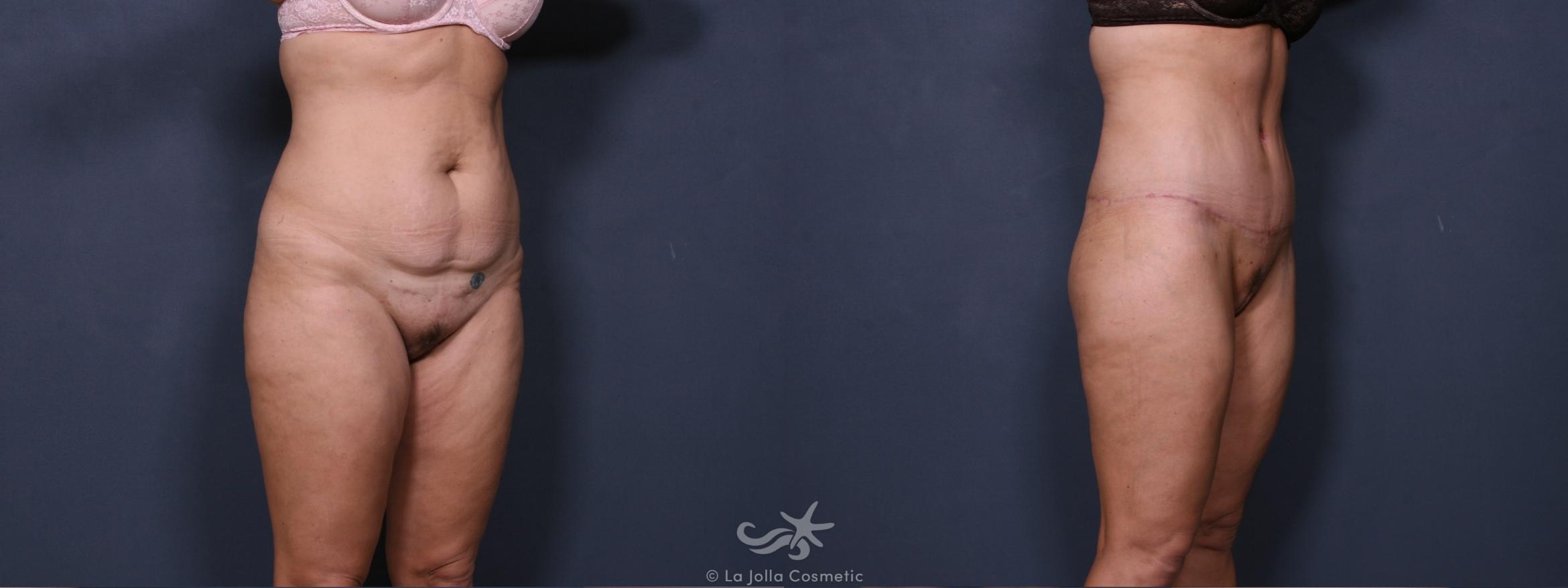Before & After Liposuction Result 363 Right Oblique View in San Diego, CA