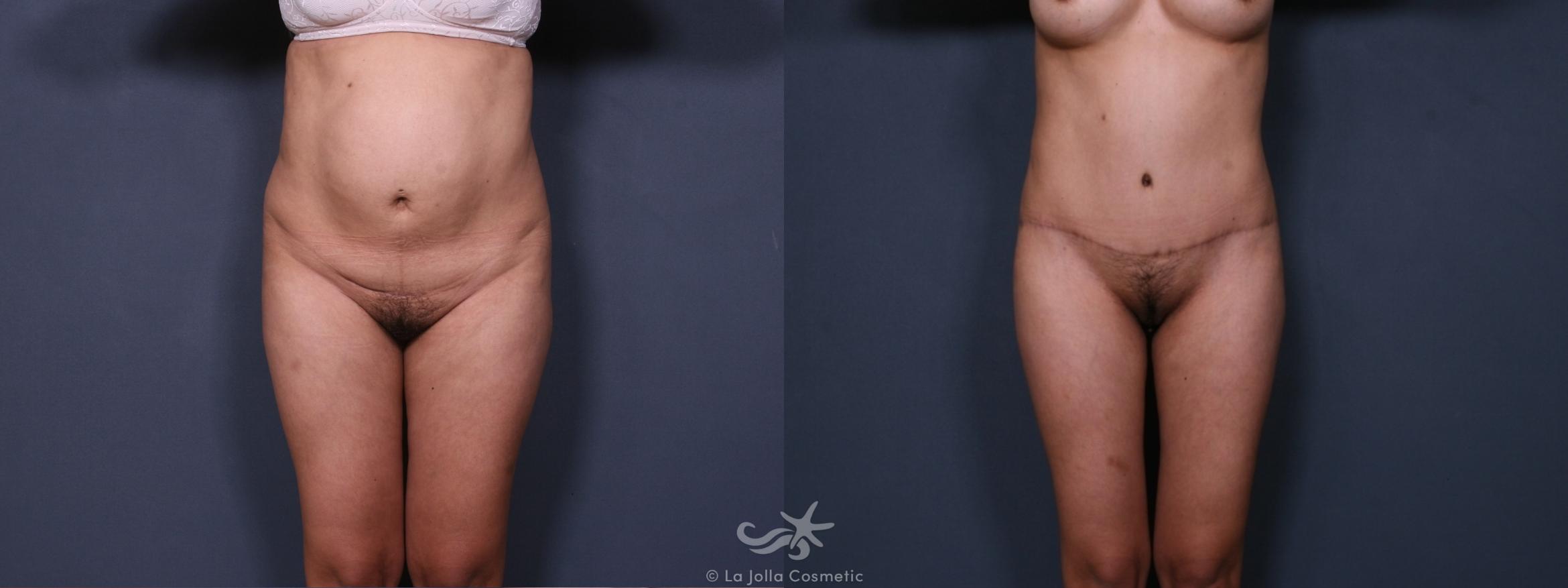 Before & After Liposuction Result 384 Front View in San Diego, CA