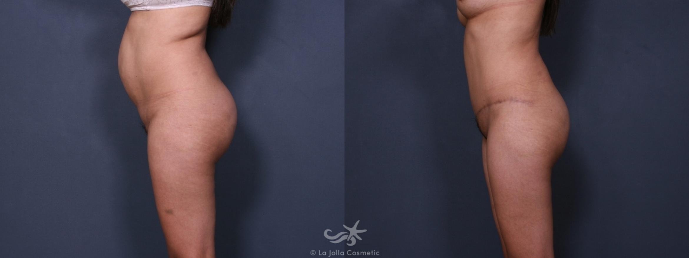 Before & After Liposuction Result 384 Left Side View in San Diego, CA