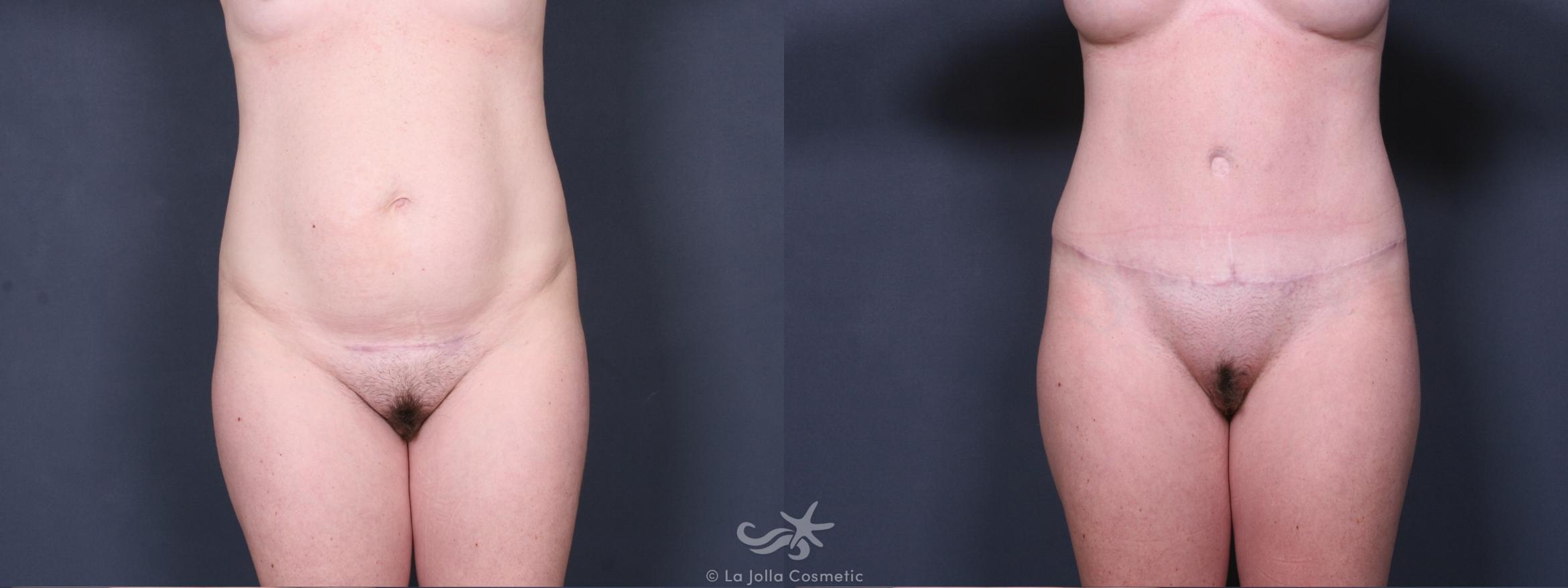 Before & After Liposuction Result 390 Front View in San Diego, CA