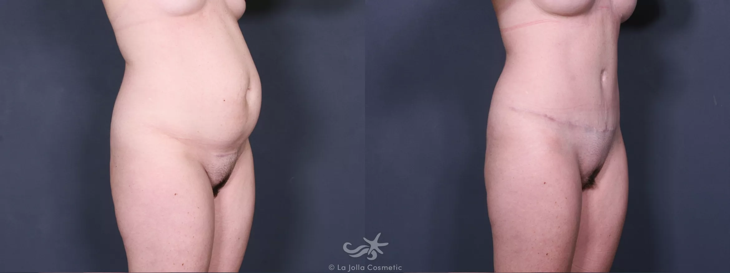 Before & After Liposuction Result 390 Right Oblique View in San Diego, CA