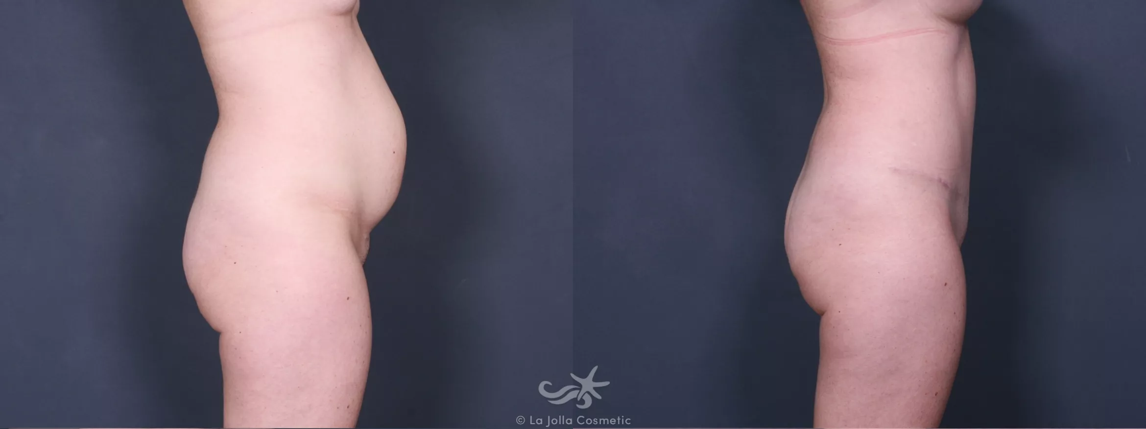 Before & After Liposuction Result 390 Right Side View in San Diego, CA