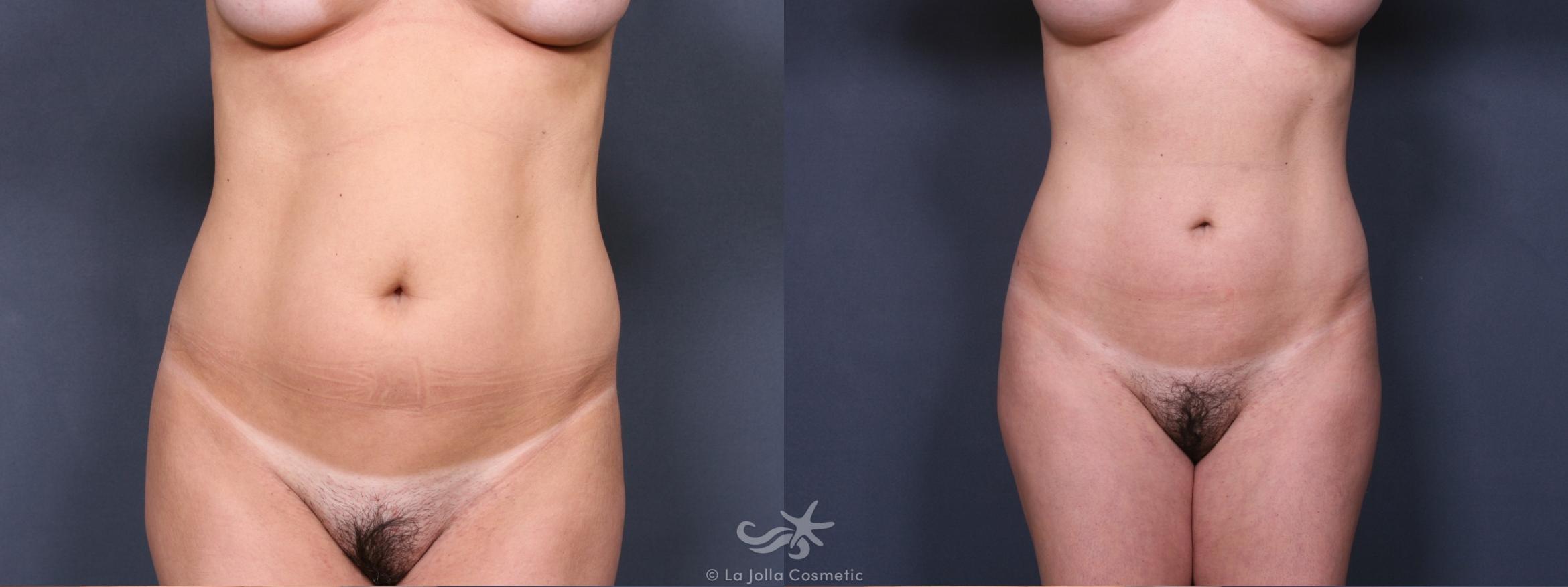 Before & After Liposuction Result 398 Front View in San Diego, CA