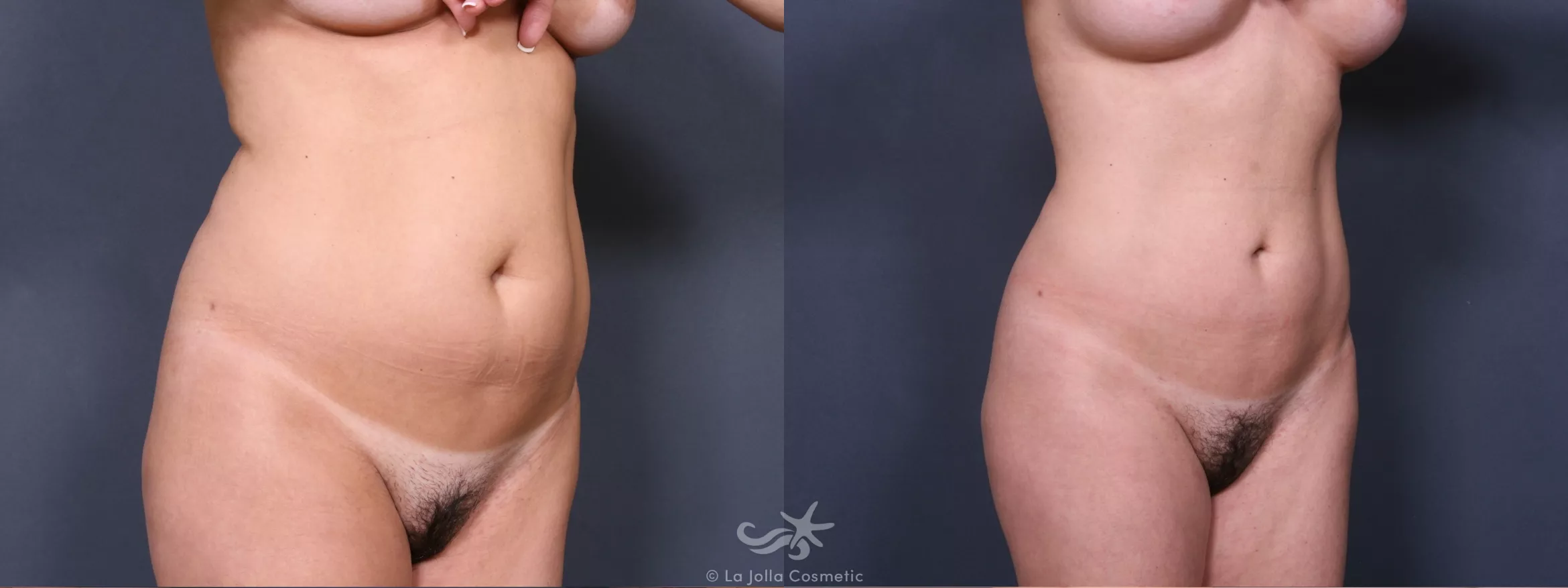 Before & After Liposuction Result 398 Right Oblique View in San Diego, CA