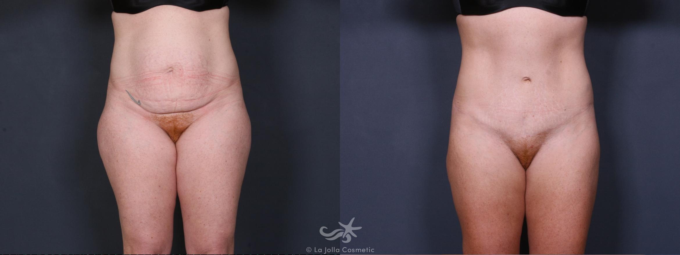 Before & After Liposuction Result 402 Front View in San Diego, CA