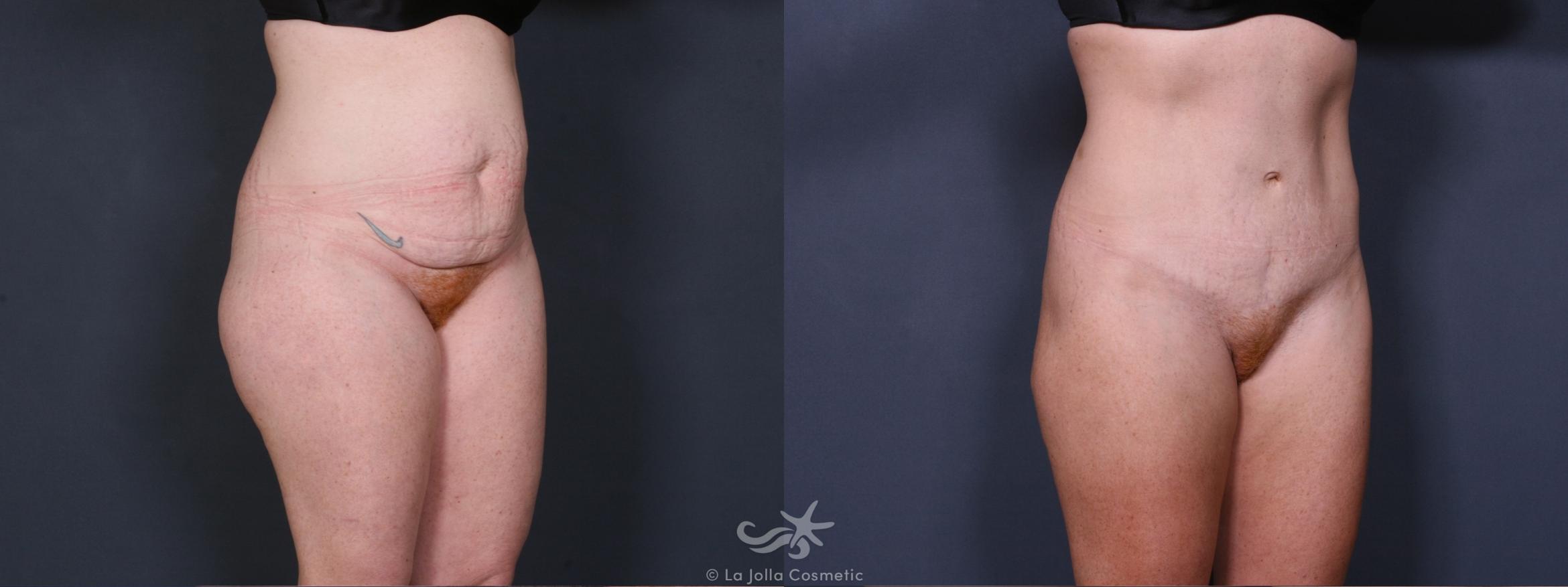 Before & After Liposuction Result 402 Right Oblique View in San Diego, CA