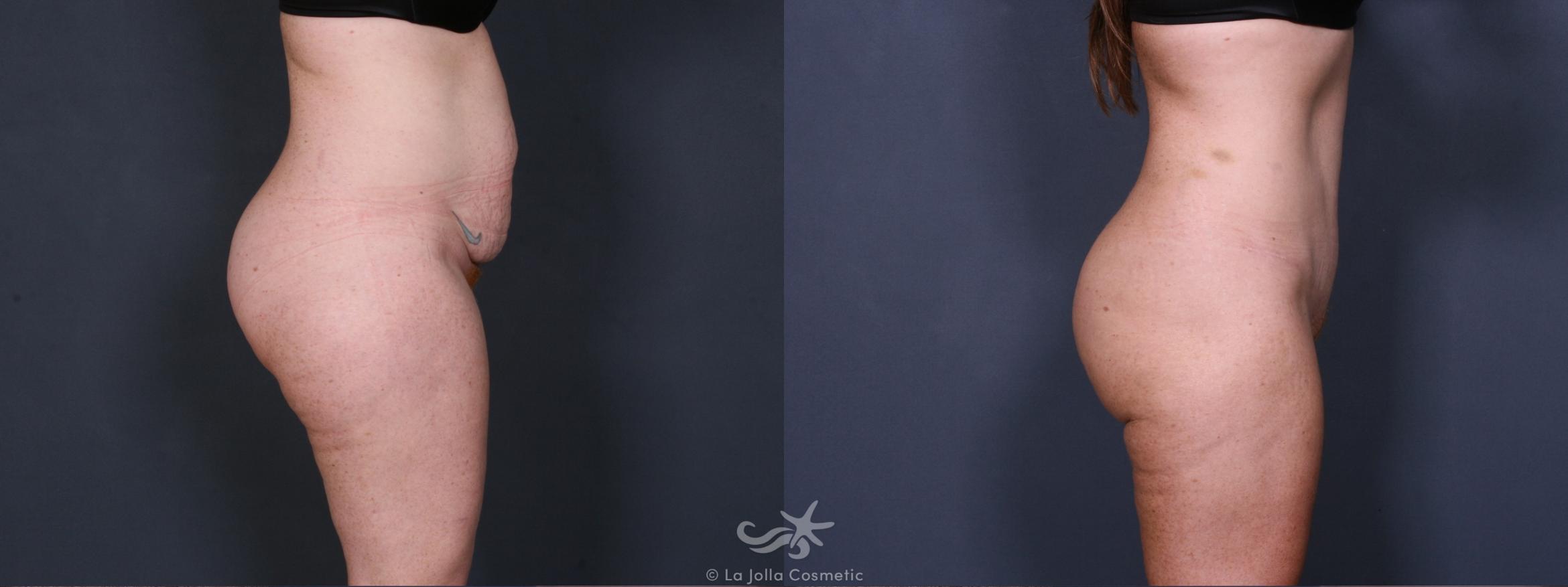Before & After Liposuction Result 402 Right Side View in San Diego, CA