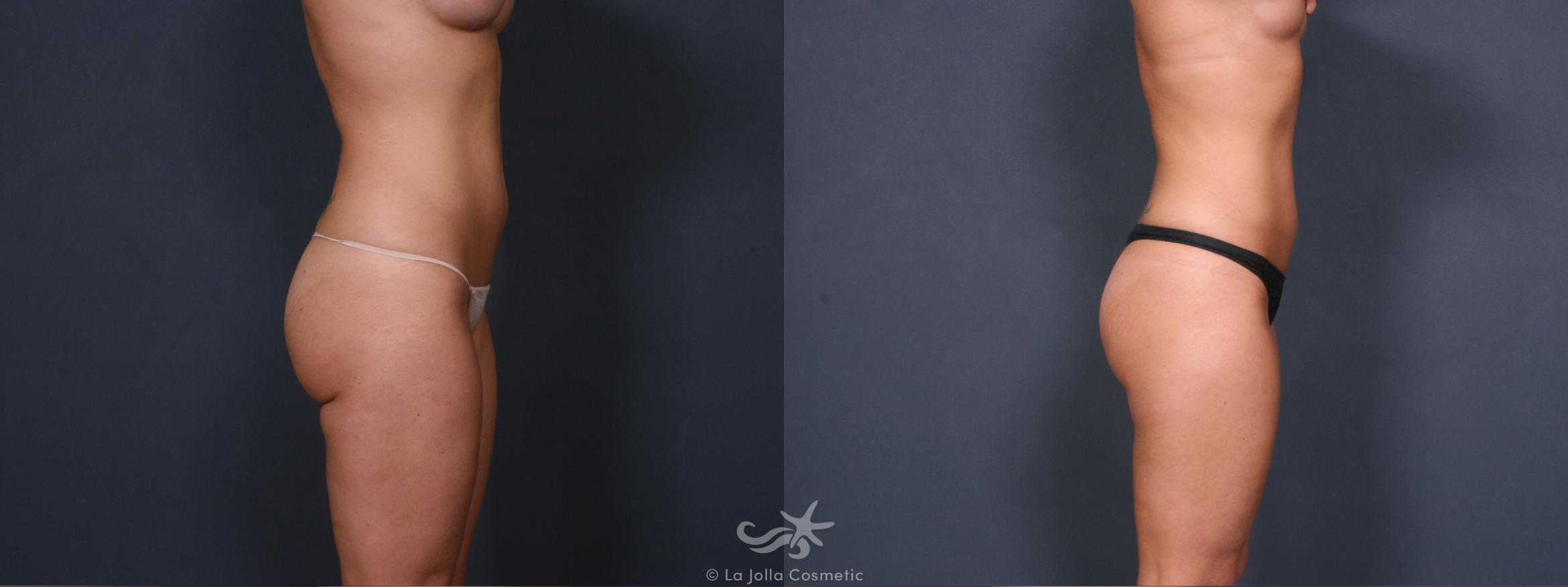 Before & After Liposuction Result 430 Right Side View in San Diego, CA