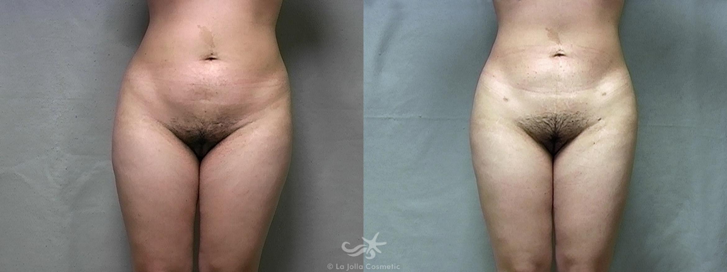 Before & After Liposuction Result 438 Front View in San Diego, CA