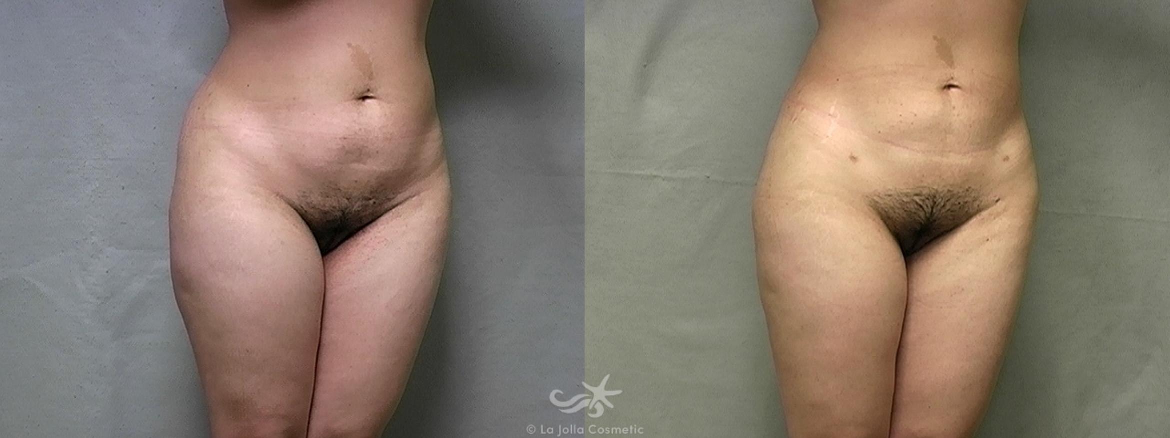Before & After Liposuction Result 438 Right Oblique View in San Diego, CA