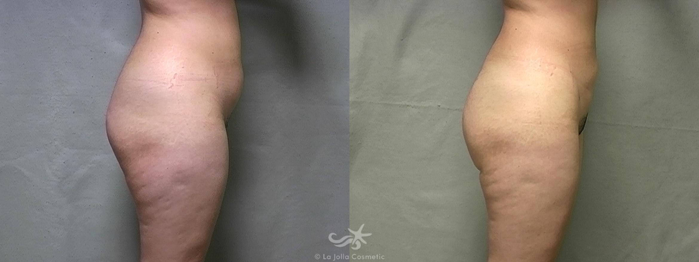 Before & After Liposuction Result 438 Right Side View in San Diego, CA