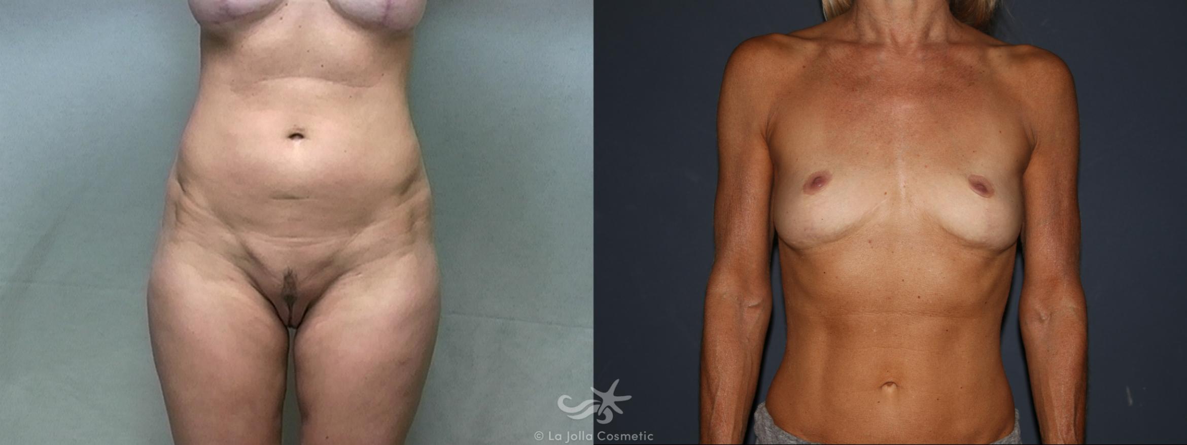 Before & After Liposuction Result 447 Front View in San Diego, CA