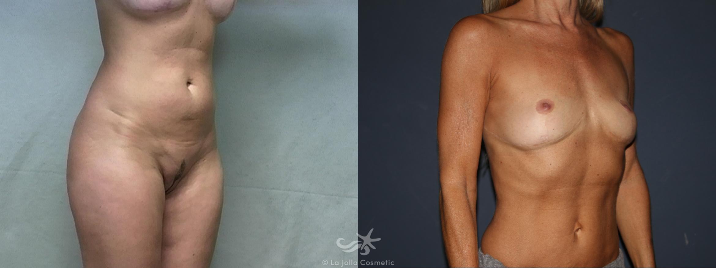 Before & After Liposuction Result 447 Right Oblique View in San Diego, CA