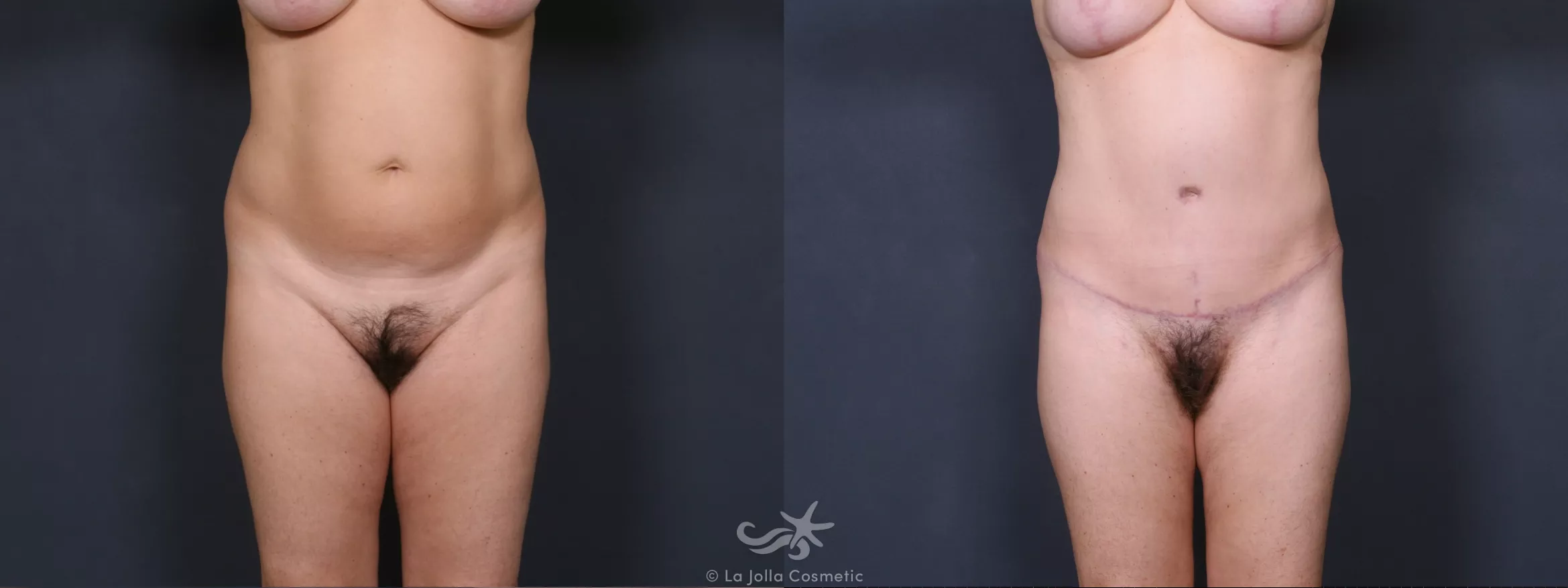 Before & After Liposuction Result 458 Front View in San Diego, CA