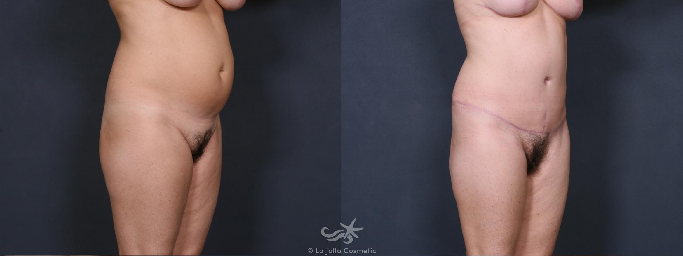Before & After Liposuction Result 458 Right Oblique View in San Diego, CA