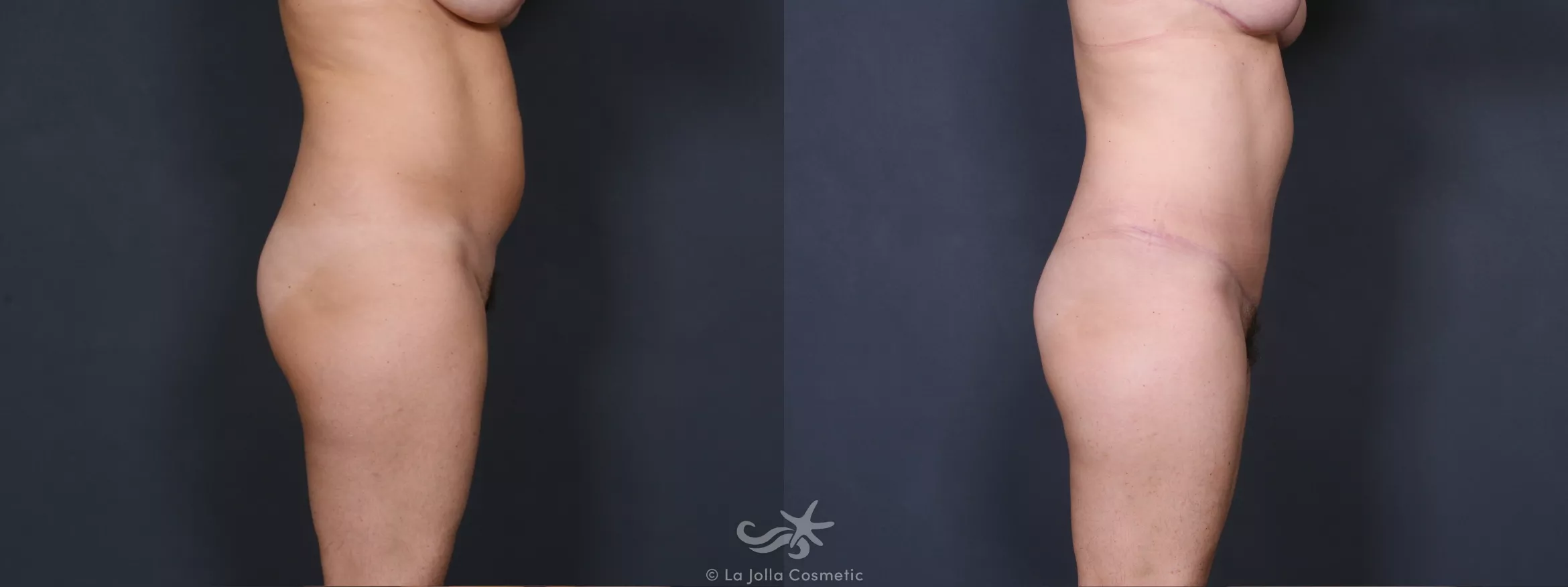 Before & After Liposuction Result 458 Right Side View in San Diego, CA