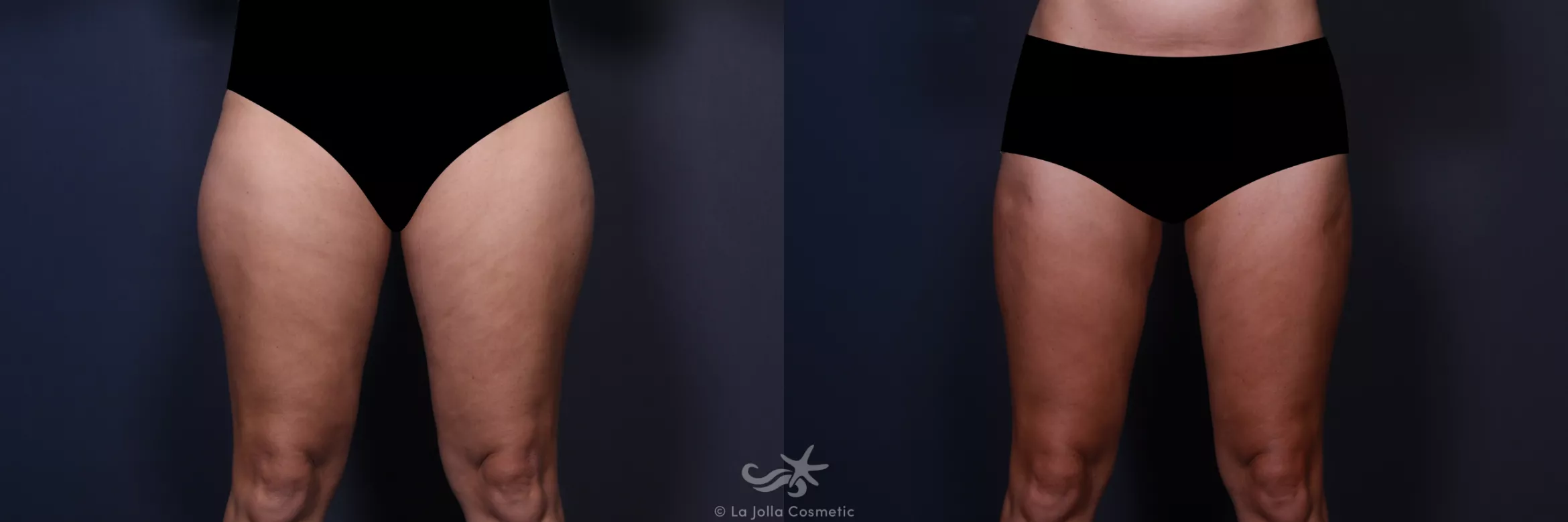 Before & After Liposuction Result 554 Front View in San Diego, CA