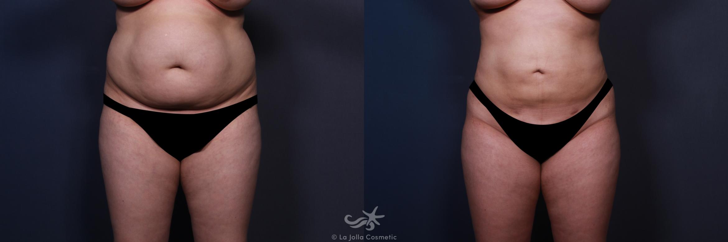 Before & After Liposuction Result 555 Front View in San Diego, CA