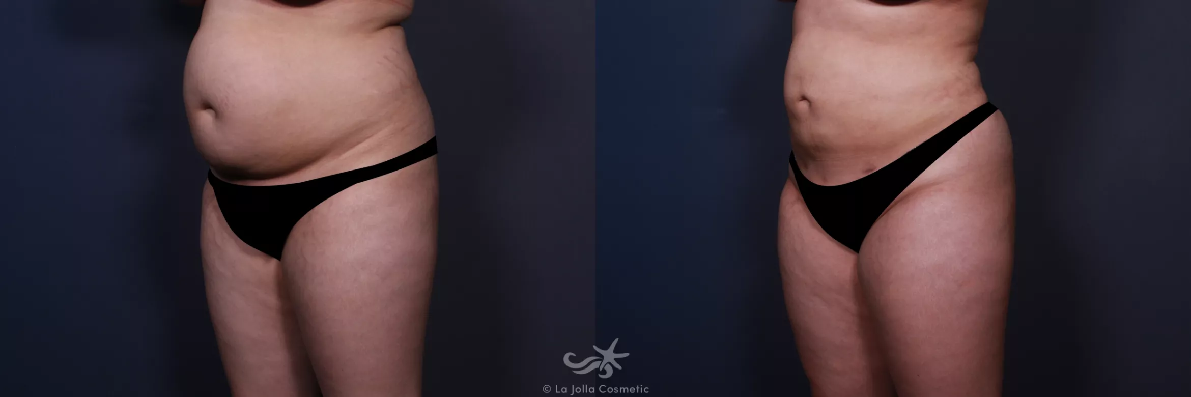 Before & After Liposuction Result 555 Left Oblique View in San Diego, CA