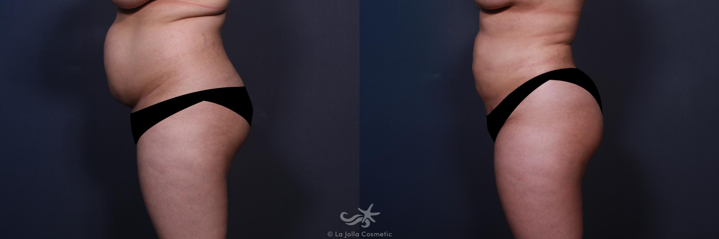 Before & After Liposuction Result 555 Left Side View in San Diego, CA