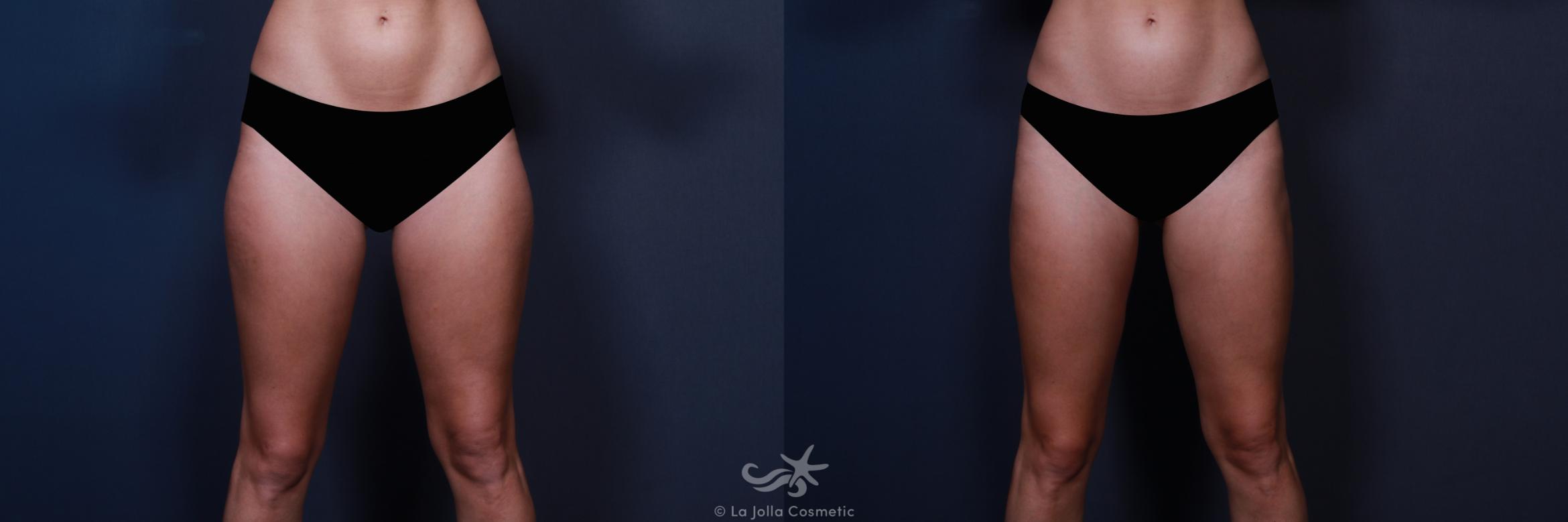 Before & After Liposuction Result 558 Front View in San Diego, CA