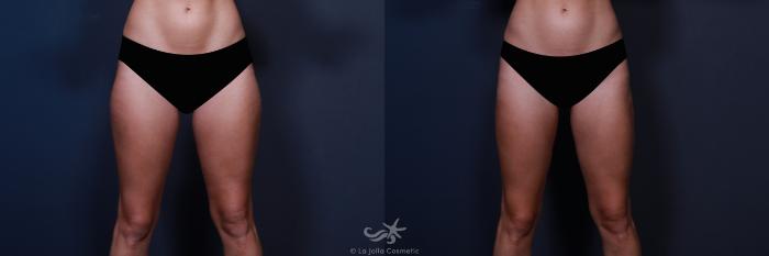 Before & After Liposuction Result 558 Front View in San Diego, Carlsbad, CA