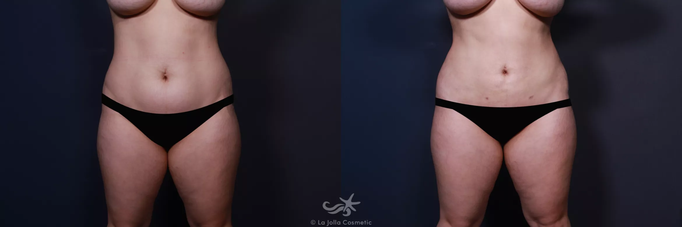 Before & After Liposuction Result 568 Front View in San Diego, CA