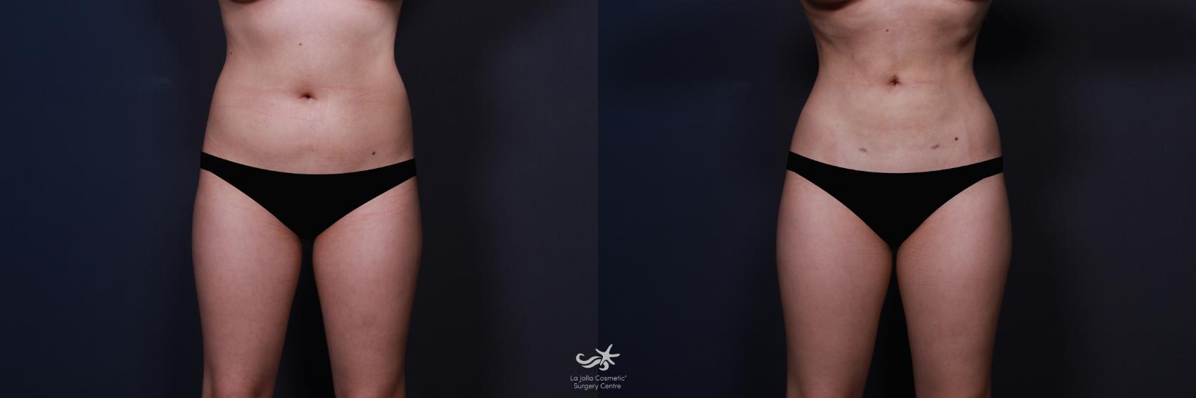 Before & After Liposuction Result 570 Front View in San Diego, CA