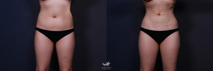 lipo after c-section before and after Liposuction & Photos | Orlando Florida Liposuction Before and After Photo