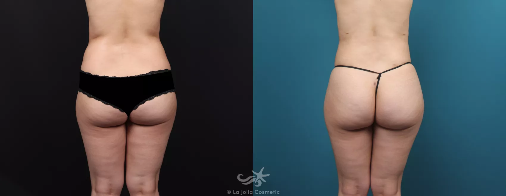 Before & After Liposuction Result 573 Back View in San Diego, CA