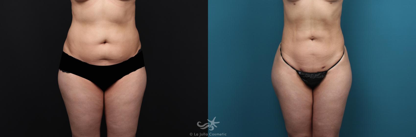 Before & After Liposuction Result 573 Front View in San Diego, CA