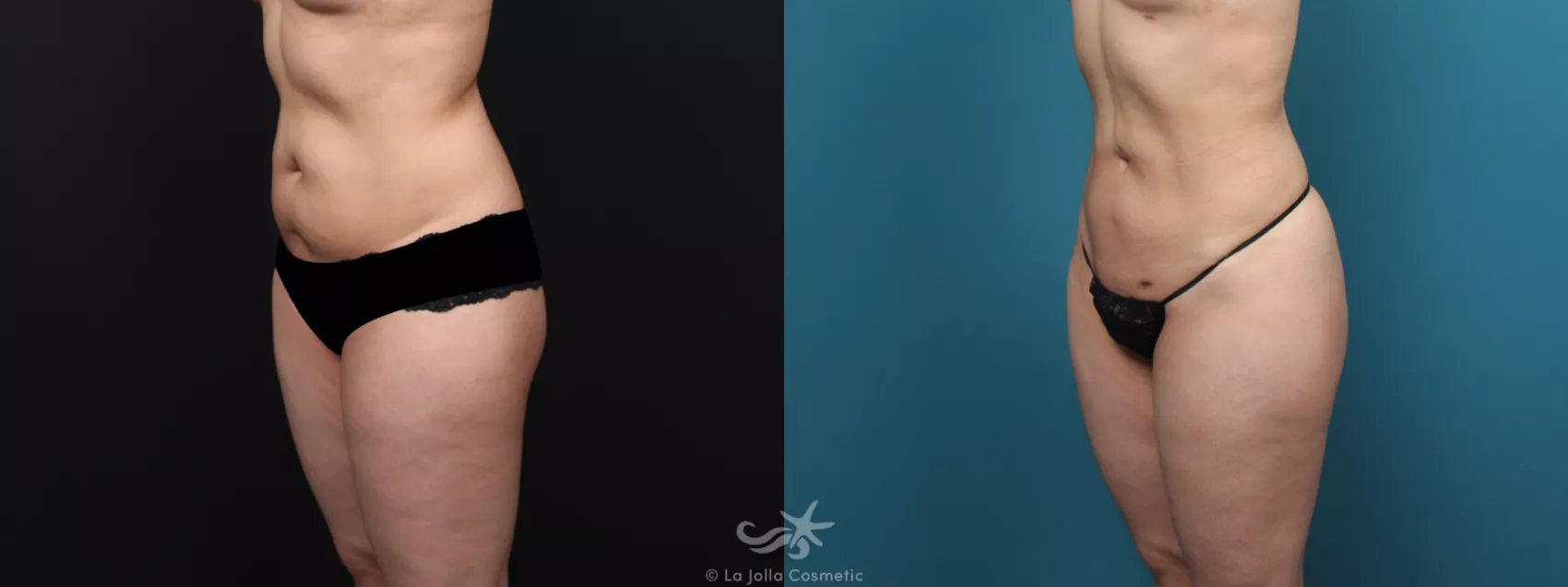 Before & After Liposuction Result 573 Left Oblique View in San Diego, CA