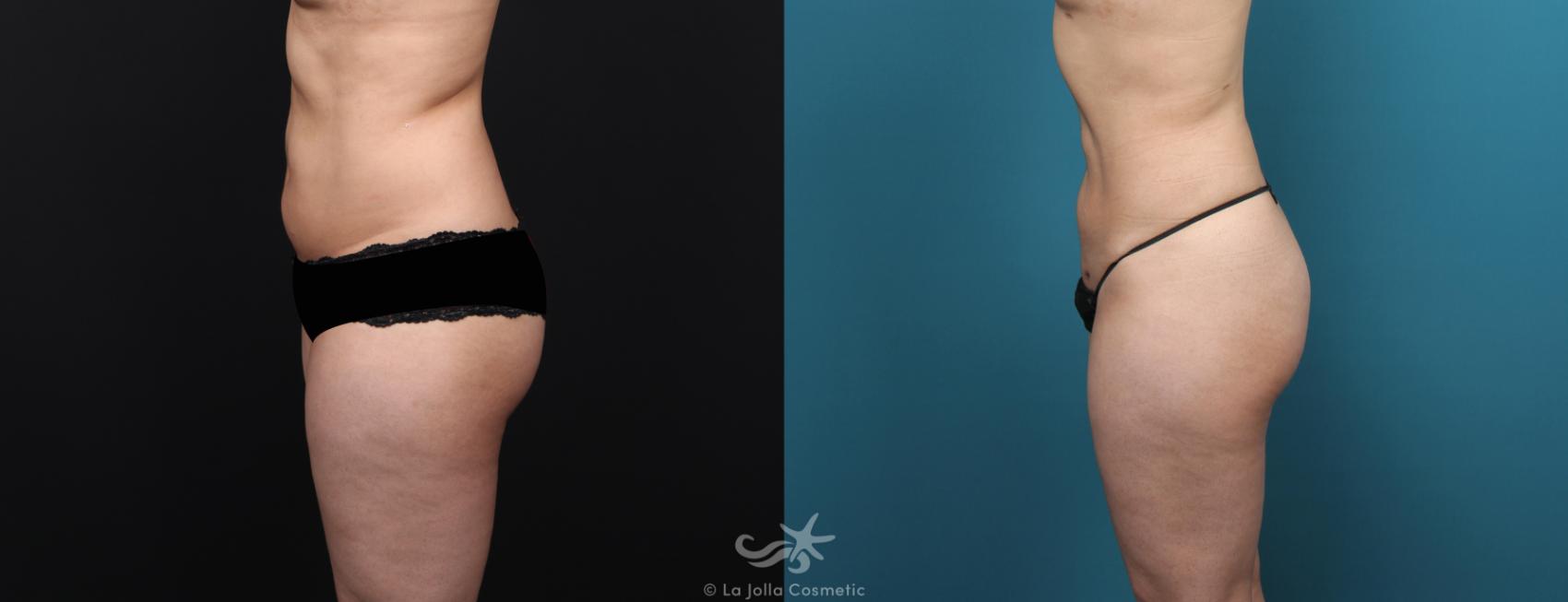 Before & After Liposuction Result 573 Left Side View in San Diego, CA
