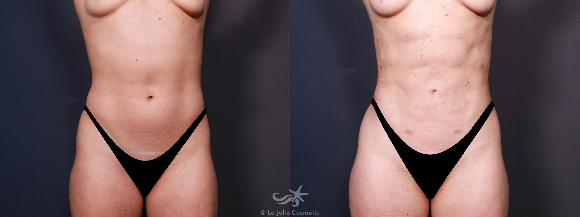 Before & After Liposuction Result 637 Front View in San Diego, Carlsbad, CA