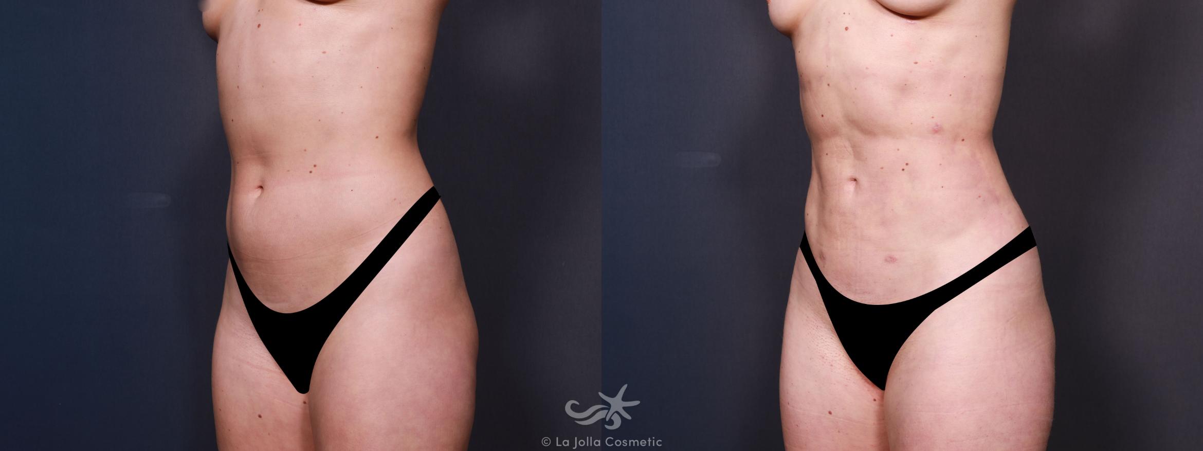 Before & After Liposuction Result 637 Left Oblique View in San Diego, CA