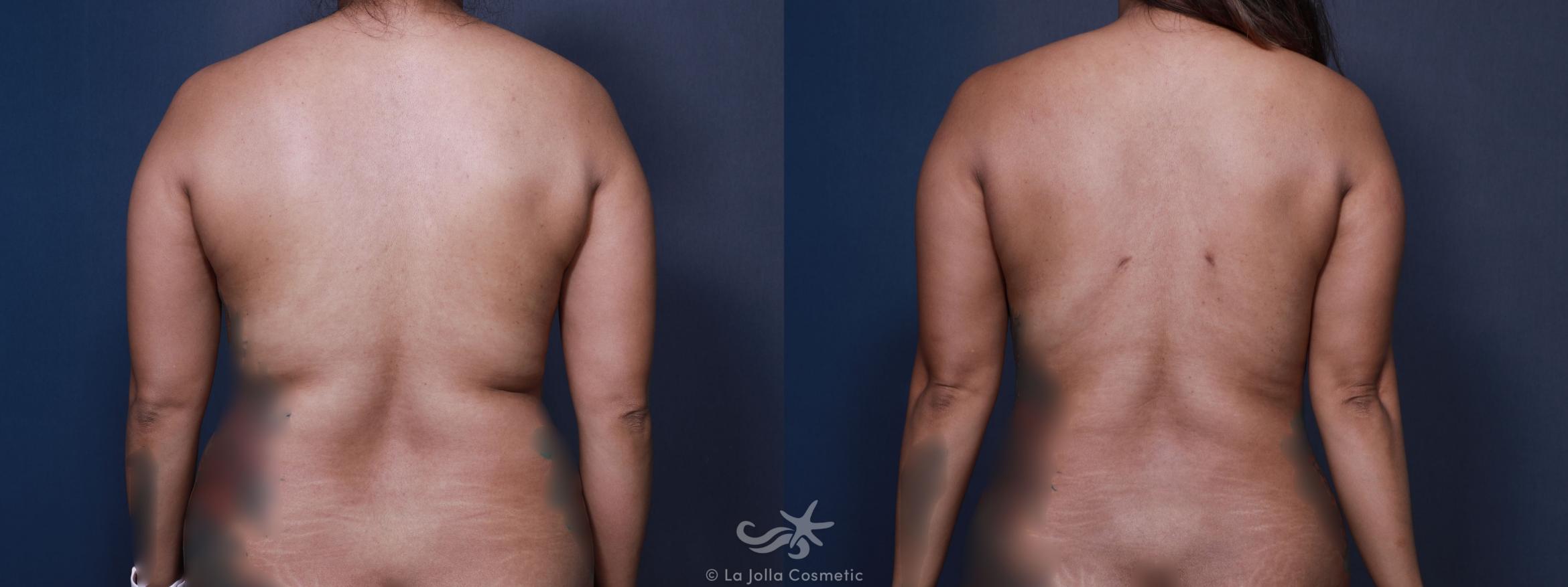 Before & After Liposuction Result 649 Back View in San Diego, CA