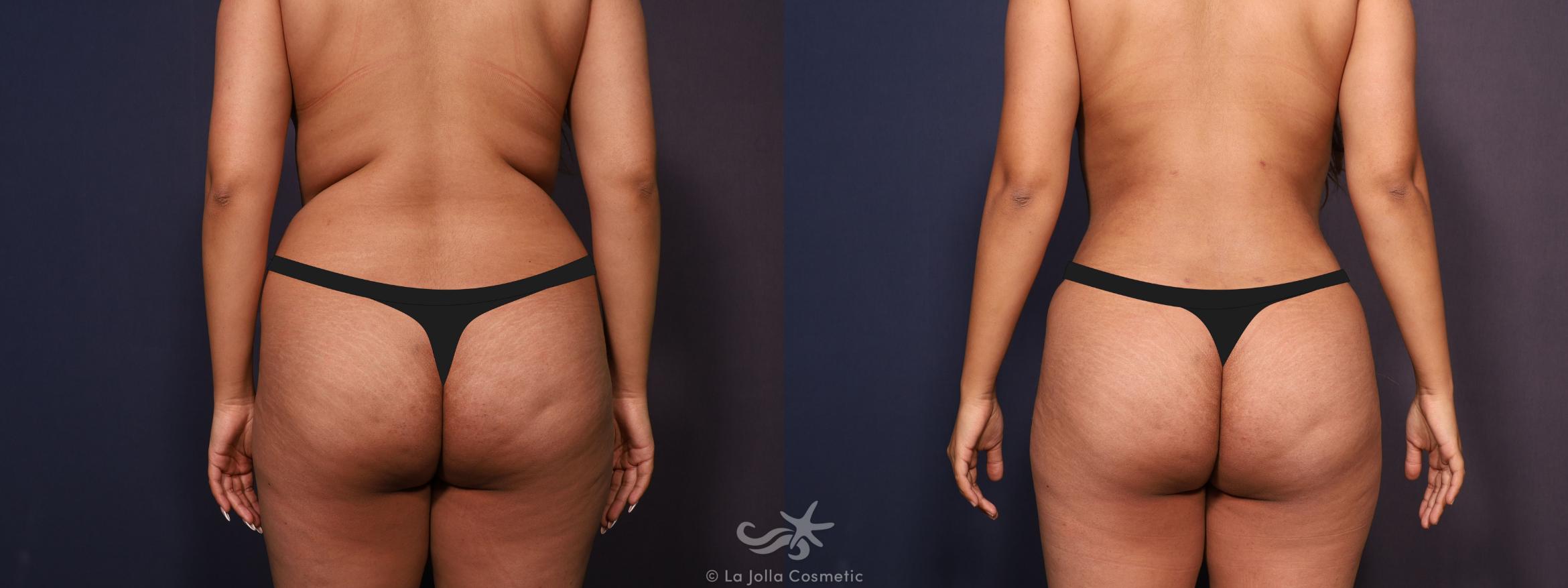 Before & After Liposuction Result 702 Back View in San Diego, CA