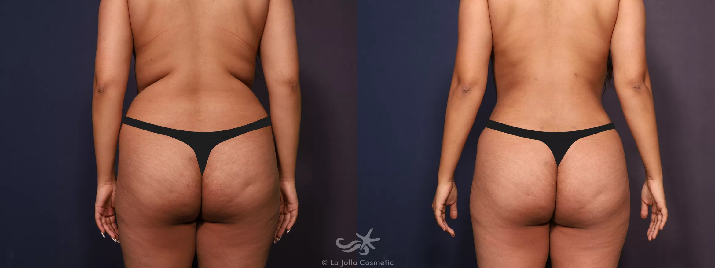 Before & After Fat Transfer Body Result 702 Back View in San Diego, CA