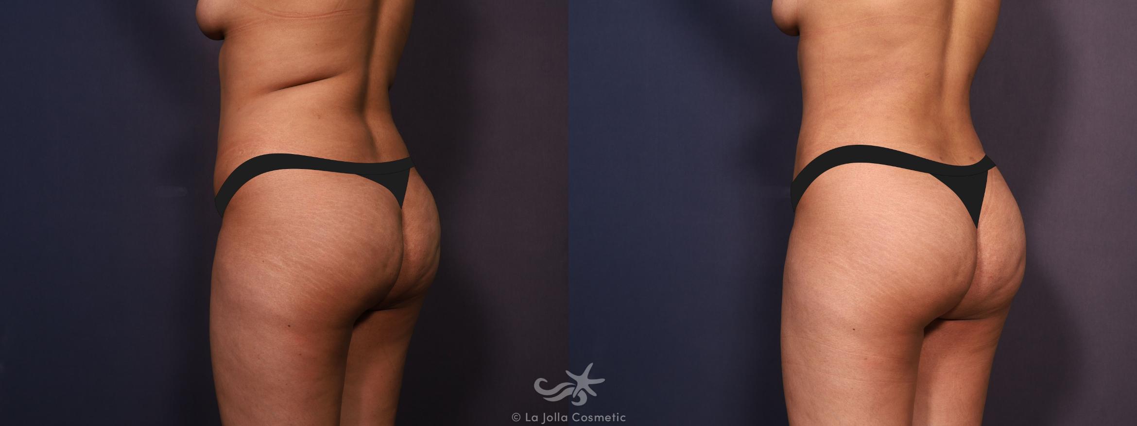 Before & After Liposuction Result 702 Left Back View in San Diego, CA