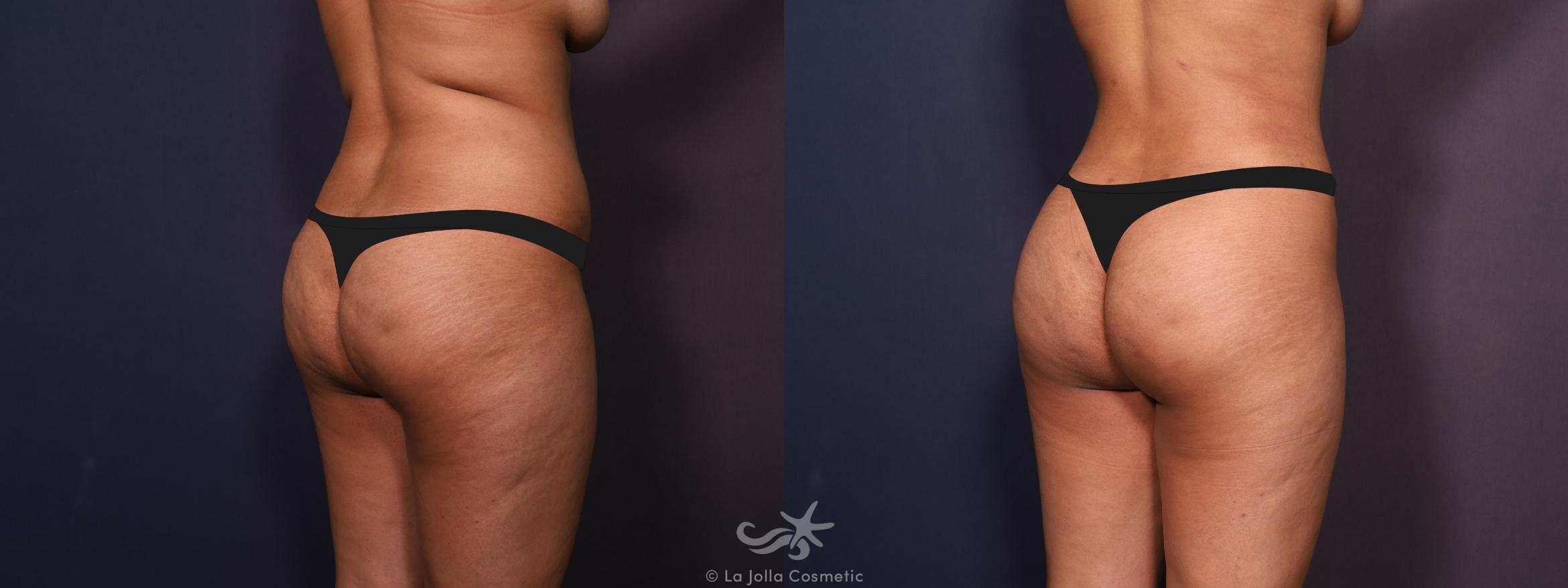Before & After Liposuction Result 702 Right Back View in San Diego, CA