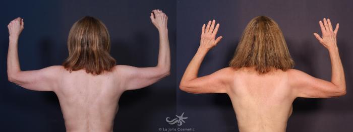 Before & After Liposuction Result 703 Back View in San Diego, Carlsbad, CA